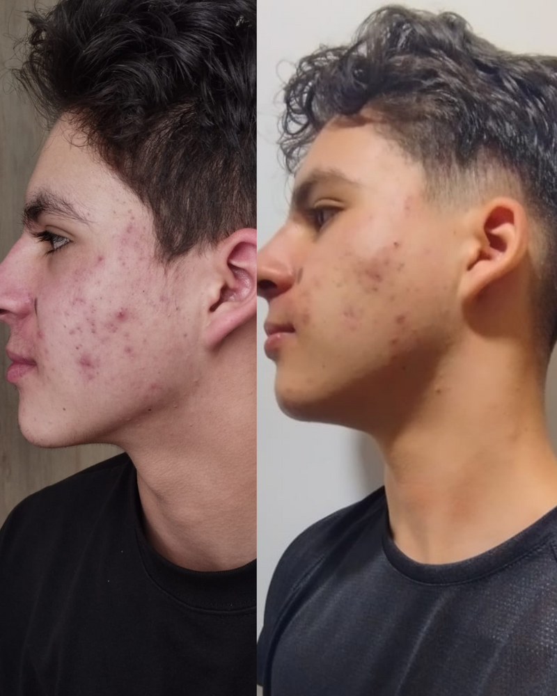 Reto de 30 dias para el acné